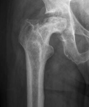 Proximal Femur Osteomyelitis